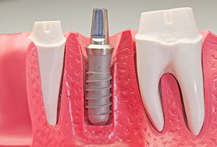 Fortedent implante dental